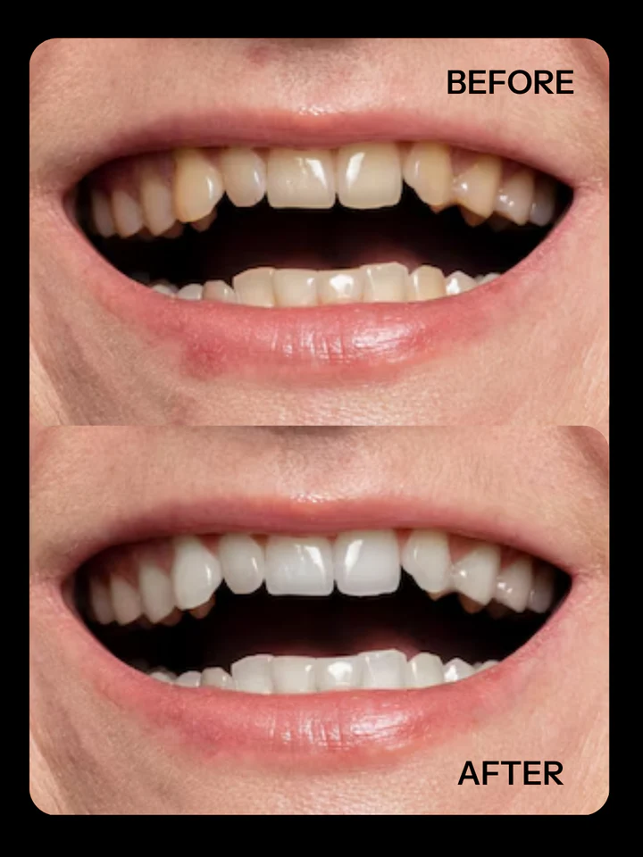 Teeth Whitening Serum - Image 3